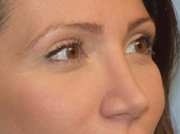 Eyelid Lift Before & After Gallery - Patient 173565775 - Image 4