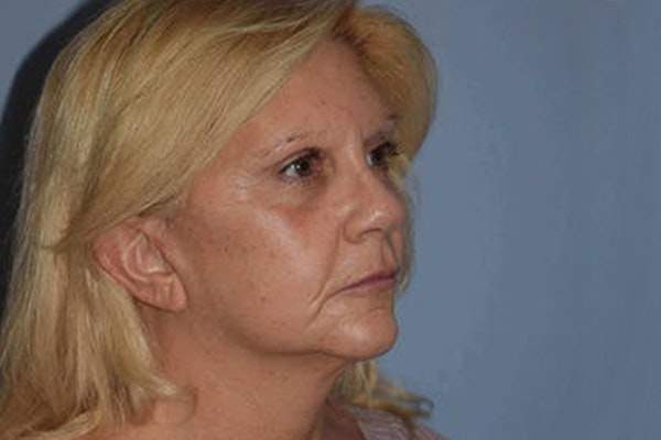 Facelift Before & After Gallery - Patient 173565773 - Image 4