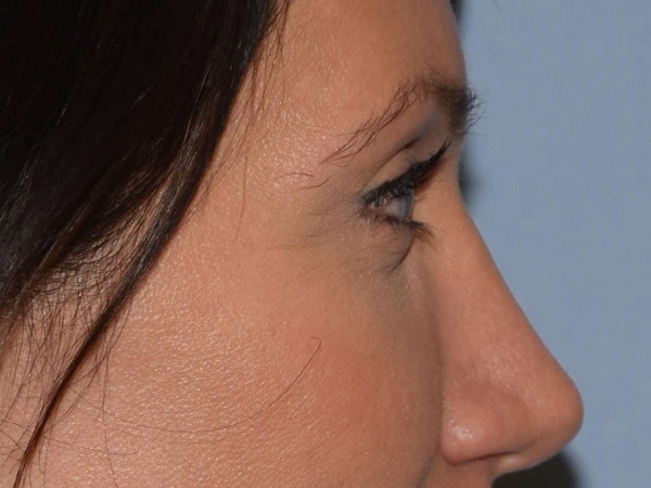 Eyelid Lift Before & After Gallery - Patient 173565775 - Image 6