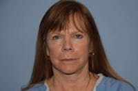 Facelift Before & After Gallery - Patient 173565793 - Image 1