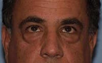Eyelid Lift Before & After Gallery - Patient 173565790 - Image 1