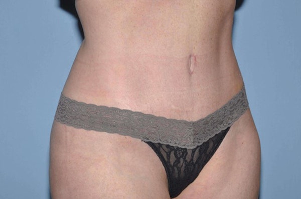 Tummy Tuck Before & After Gallery - Patient 173565789 - Image 4