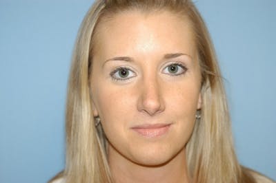 Rhinoplasty Before & After Gallery - Patient 173565788 - Image 4