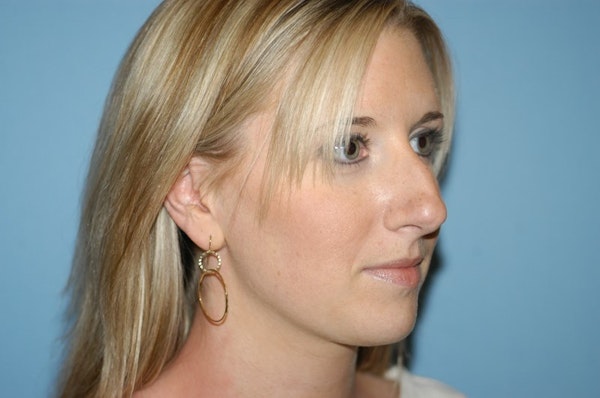 Rhinoplasty Before & After Gallery - Patient 173565788 - Image 5