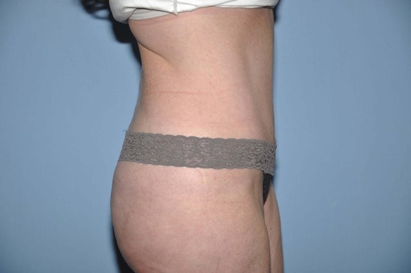 Tummy Tuck Before & After Gallery - Patient 173565789 - Image 6