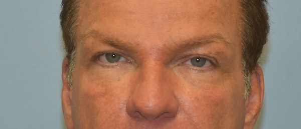 Eyelid Lift Before & After Gallery - Patient 173565803 - Image 1