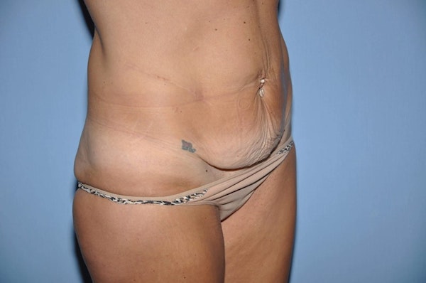 Tummy Tuck Before & After Gallery - Patient 173565802 - Image 3