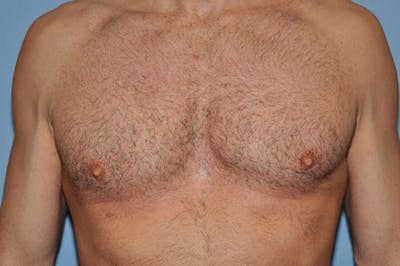 Gynecomastia Before & After Gallery - Patient 173565809 - Image 2