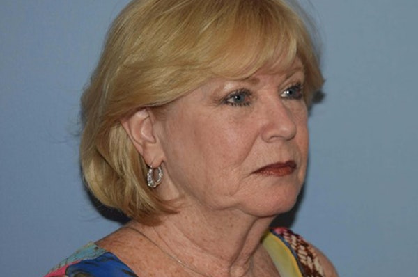 Facelift Before & After Gallery - Patient 173565808 - Image 3