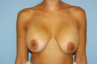 Breast Revision Before & After Gallery - Patient 173565819 - Image 1