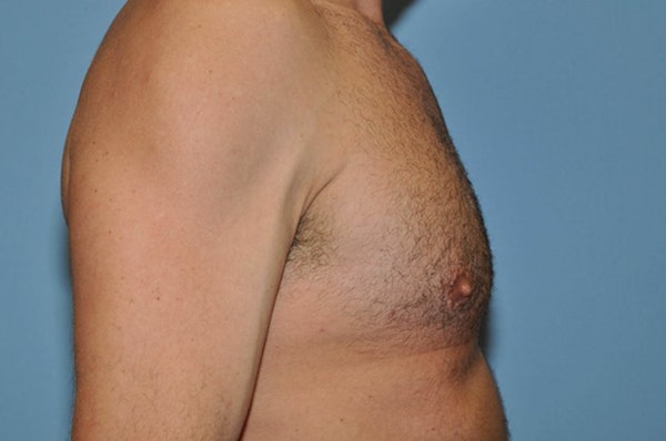Gynecomastia Before & After Gallery - Patient 173565809 - Image 6