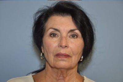 Facelift Before & After Gallery - Patient 173565821 - Image 1