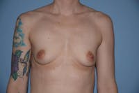 Breast Augmentation Before & After Gallery - Patient 173565822 - Image 1