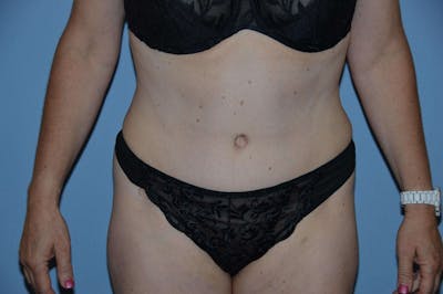 Tummy Tuck Before & After Gallery - Patient 173565825 - Image 2