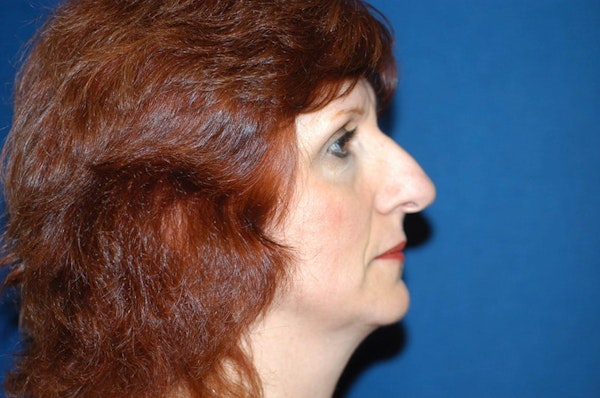 Rhinoplasty Before & After Gallery - Patient 173565826 - Image 1