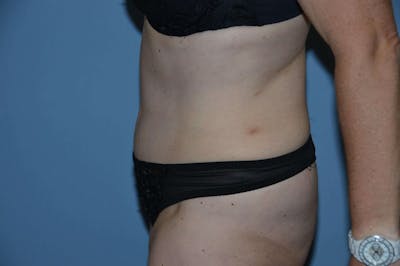 Tummy Tuck Before & After Gallery - Patient 173565825 - Image 6