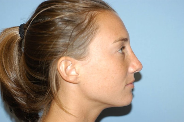 Rhinoplasty Before & After Gallery - Patient 173565972 - Image 2