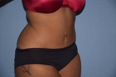 Tummy Tuck Before & After Gallery - Patient 173565907 - Image 4