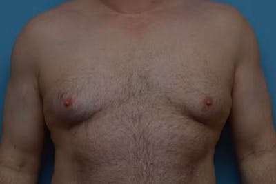 Gynecomastia Before & After Gallery - Patient 173565974 - Image 1