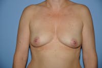 Breast Augmentation Before & After Gallery - Patient 173566027 - Image 1