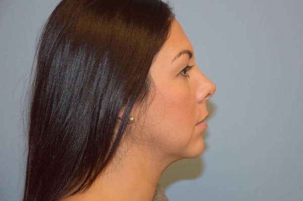 Facelift Before & After Gallery - Patient 173566032 - Image 5