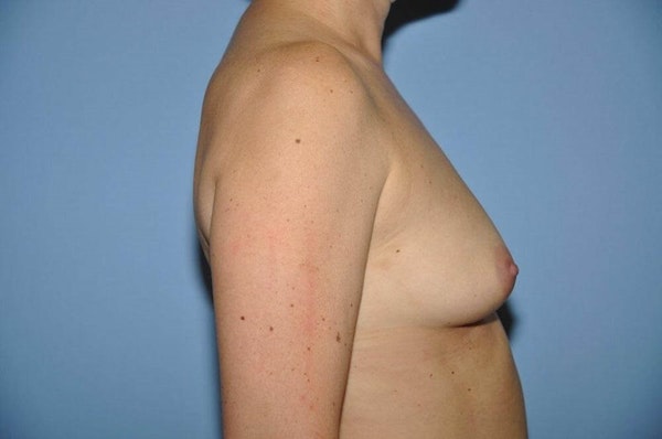 Breast Augmentation Before & After Gallery - Patient 173566027 - Image 5