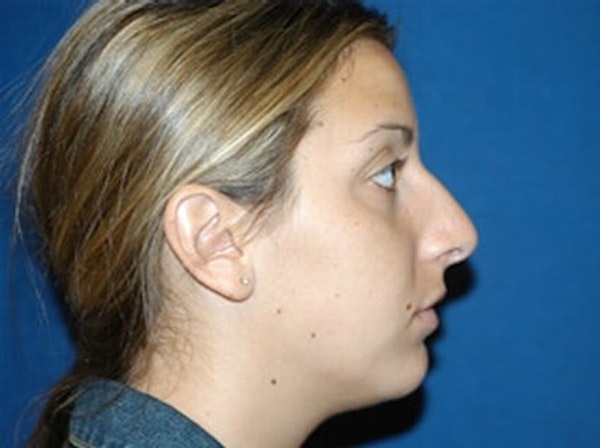 Rhinoplasty Before & After Gallery - Patient 173566164 - Image 1
