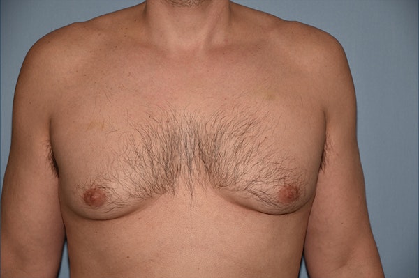 Gynecomastia Before & After Gallery - Patient 173566207 - Image 1