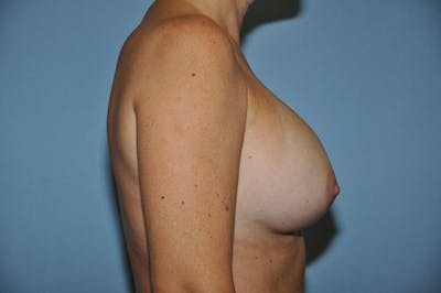 Breast Augmentation Before & After Gallery - Patient 173566027 - Image 6