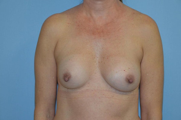 Breast Revision Before & After Gallery - Patient 173566248 - Image 1