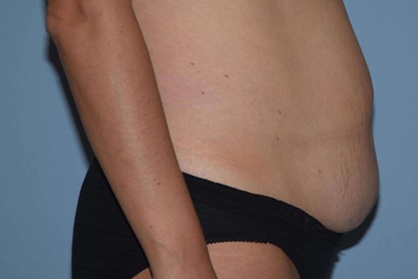 Tummy Tuck Before & After Gallery - Patient 173566106 - Image 5