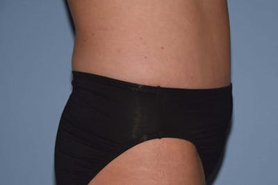Tummy Tuck Before & After Gallery - Patient 173566106 - Image 6