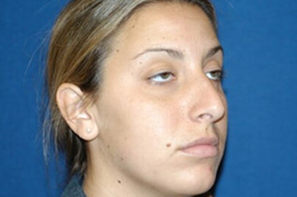 Rhinoplasty Before & After Gallery - Patient 173566164 - Image 5