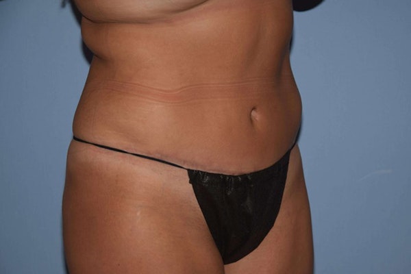 Tummy Tuck Before & After Gallery - Patient 173566291 - Image 4