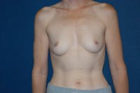 Breast Augmentation Before & After Gallery - Patient 173566338 - Image 1