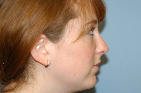 Rhinoplasty Before & After Gallery - Patient 173566346 - Image 2