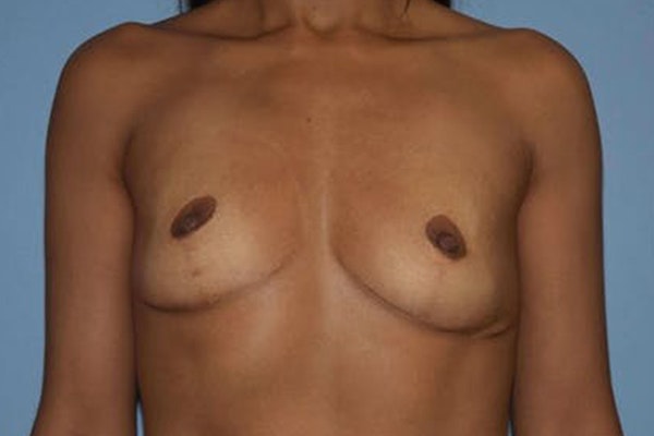 Breast Revision Before & After Gallery - Patient 173566355 - Image 1
