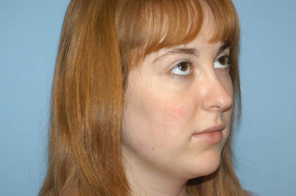 Rhinoplasty Before & After Gallery - Patient 173566346 - Image 6