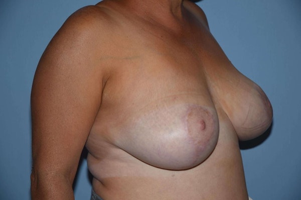 Breast Reduction Before & After Gallery - Patient 173566366 - Image 4