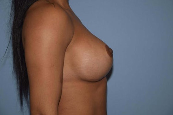 Breast Revision Before & After Gallery - Patient 173566355 - Image 6