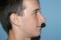 Rhinoplasty Before & After Gallery - Patient 173566373 - Image 1