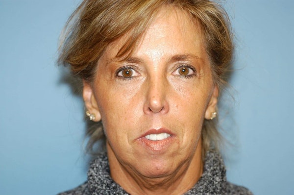 Facelift Before & After Gallery - Patient 173566375 - Image 1