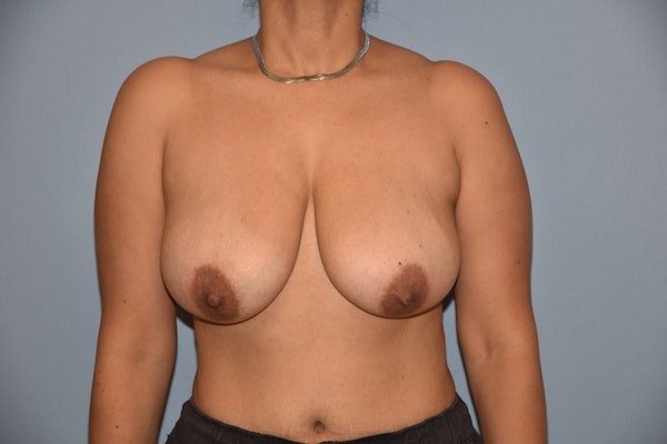Breast Lift Before & After Gallery - Patient 173566398 - Image 1