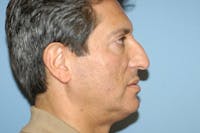Rhinoplasty Before & After Gallery - Patient 173566387 - Image 1
