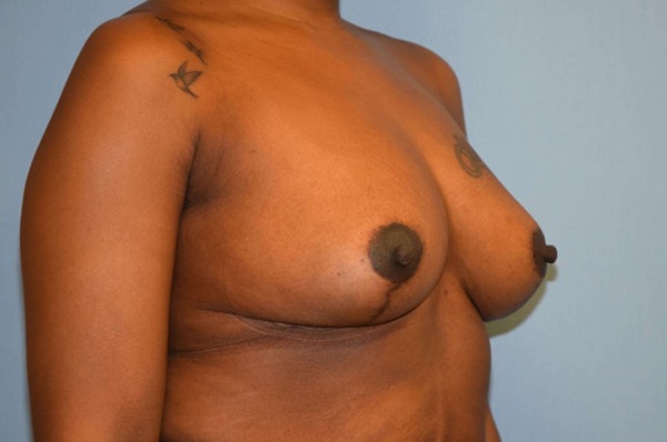 Breast Reduction Before & After Gallery - Patient 173566386 - Image 4