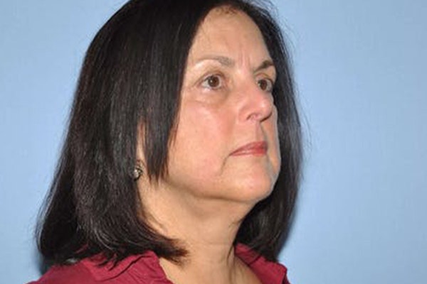 Facelift Before & After Gallery - Patient 173566385 - Image 5