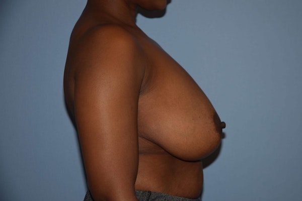 Breast Reduction Before & After Gallery - Patient 173566386 - Image 5
