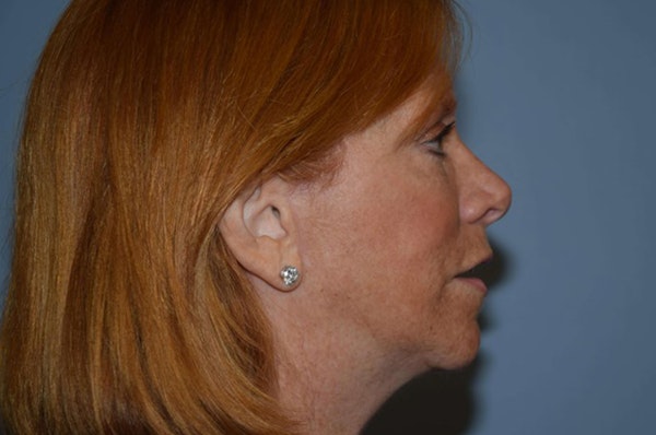 Facelift Before & After Gallery - Patient 173566395 - Image 6