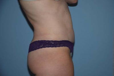 Tummy Tuck Before & After Gallery - Patient 173566396 - Image 6