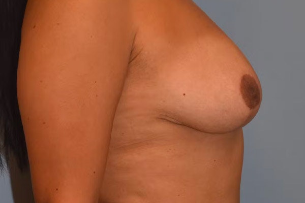 Breast Lift Before & After Gallery - Patient 173566398 - Image 6